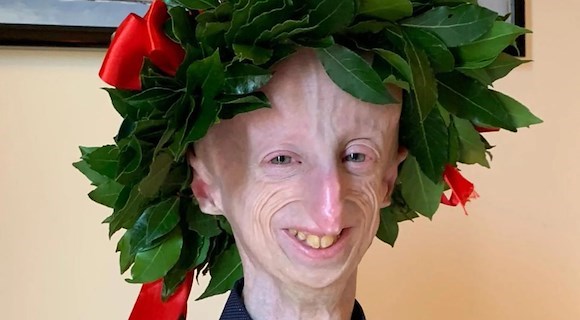 L'Italia piange Sammy Basso, addio al biologo 28enne che ha fatto conoscere la progeria